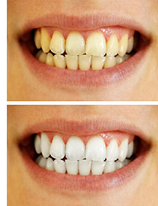 Teeth whitening before and after results 