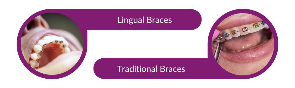 Lingual vs Traditional Braces