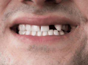 Man before dental implants at Harwood dental practice