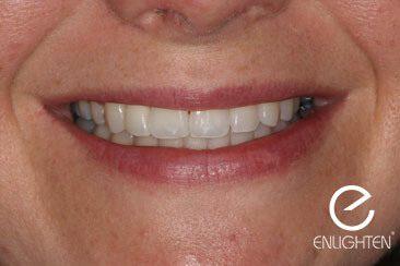 a woman with straight teeth and white smile after visiting Harwood Dental Care.