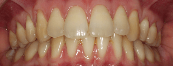 Teeth Whitening Before