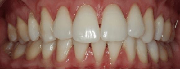 Teeth Whitening After