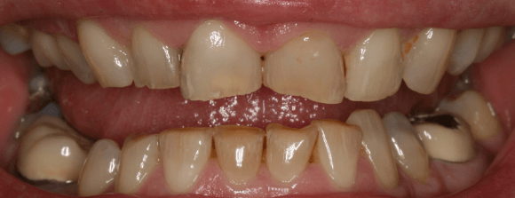 Teeth Whitening Before