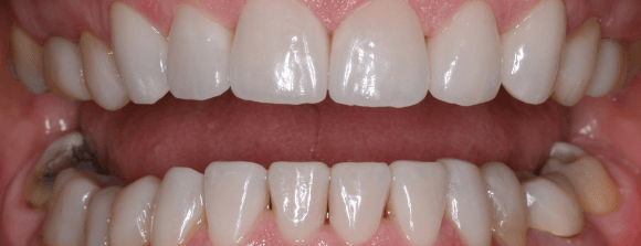 Teeth Whitening After