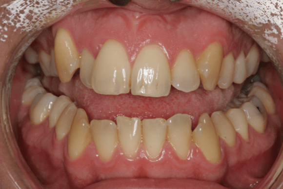 Teeth Whitening Before