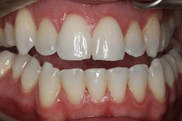Teeth Whitening After