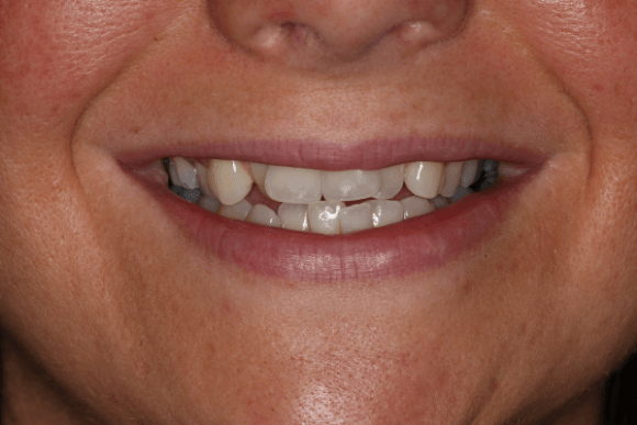 Teeth Whitening Before