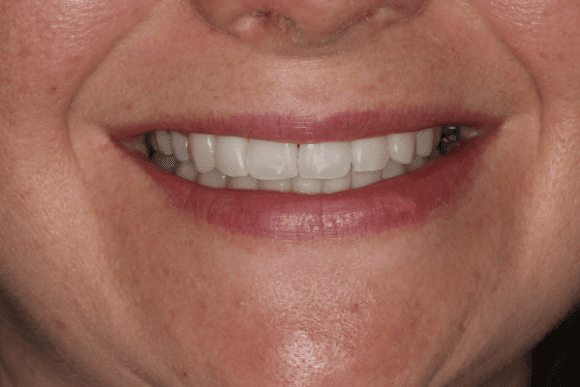 Teeth Whitening After