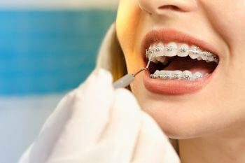 Woman with dental instrument in her mouth cleaning her braces