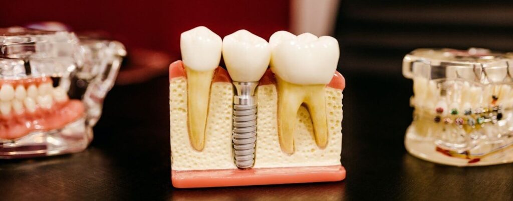 Cross section of gum with a Dental Implant fitted.