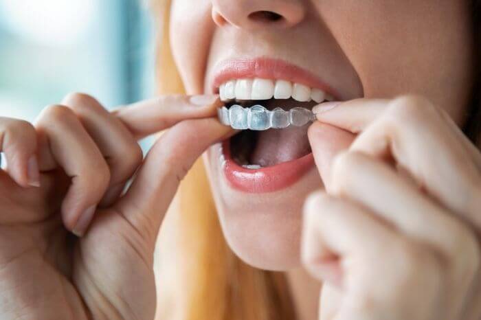 Health Benefits of Invisalign at Harwood Dental