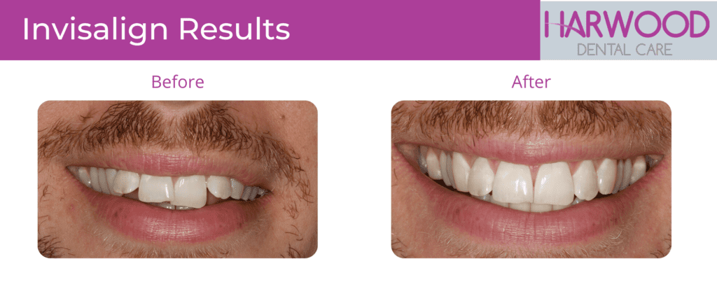 Invisalign Braces in Harwood, Bolton