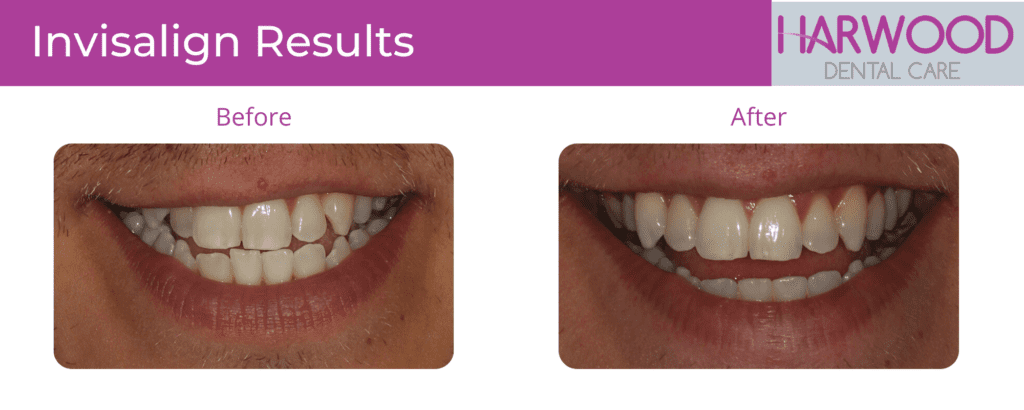 Image showing the before and after results of Invisalign Braces