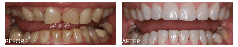 Does teeth whitening damage enamel?
