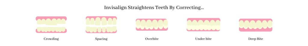 Invisalign straightens teeth by correcting 