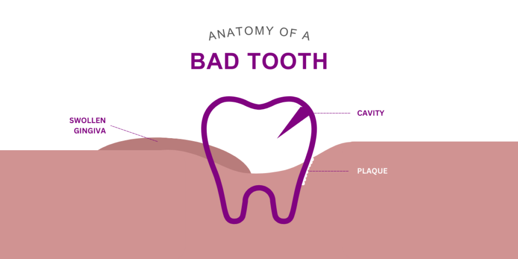 Anatomy of a bad tooth - Harwood Dental Care - Harwood, Bolton