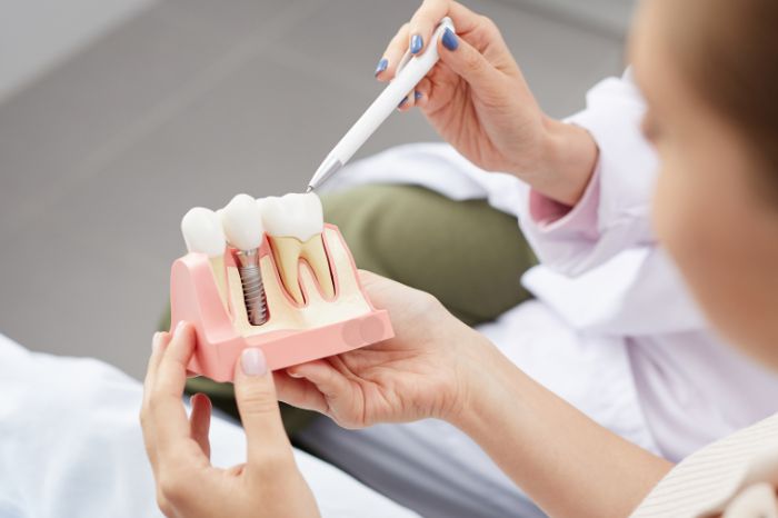 Introduction to Dental Implants at Harwood Dental Care