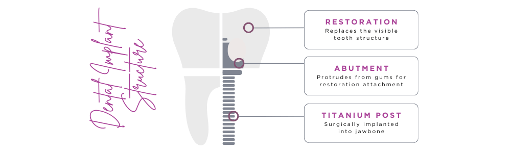 dental implant structure - Bolton dental practice in Harwood