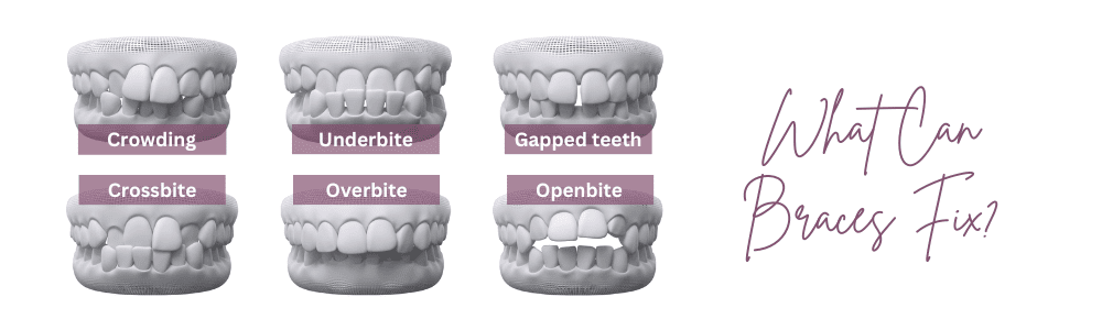 what can braces fix? - Harwood Dental Care - Harwood, Bolton