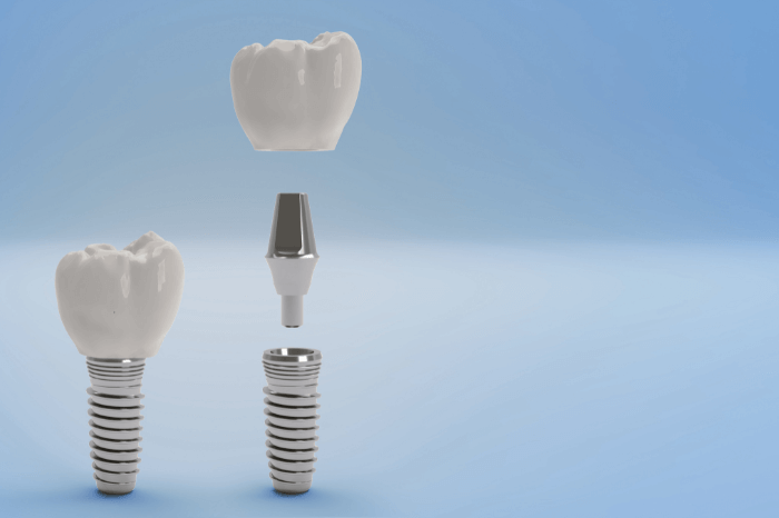 Two dental implant prosthesis