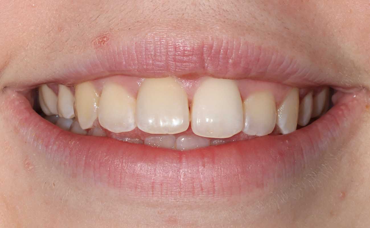 Treatment Before Image Reading | Aspire Clinic