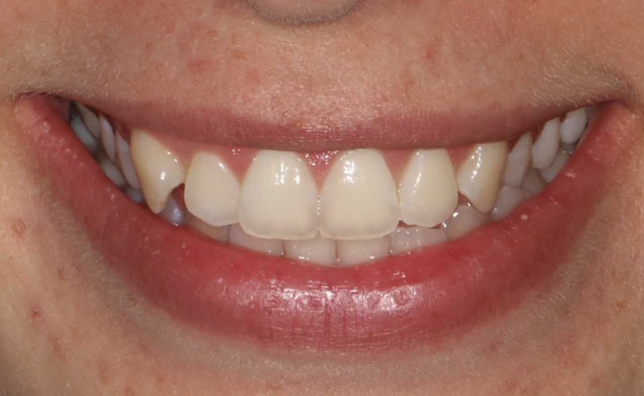 Treatment Before Image Reading | Aspire Clinic
