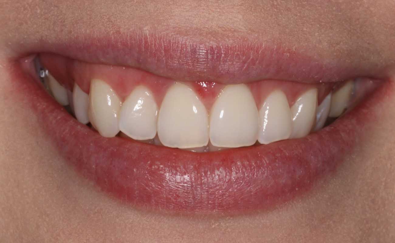 Treatment Before Image Reading | Aspire Clinic