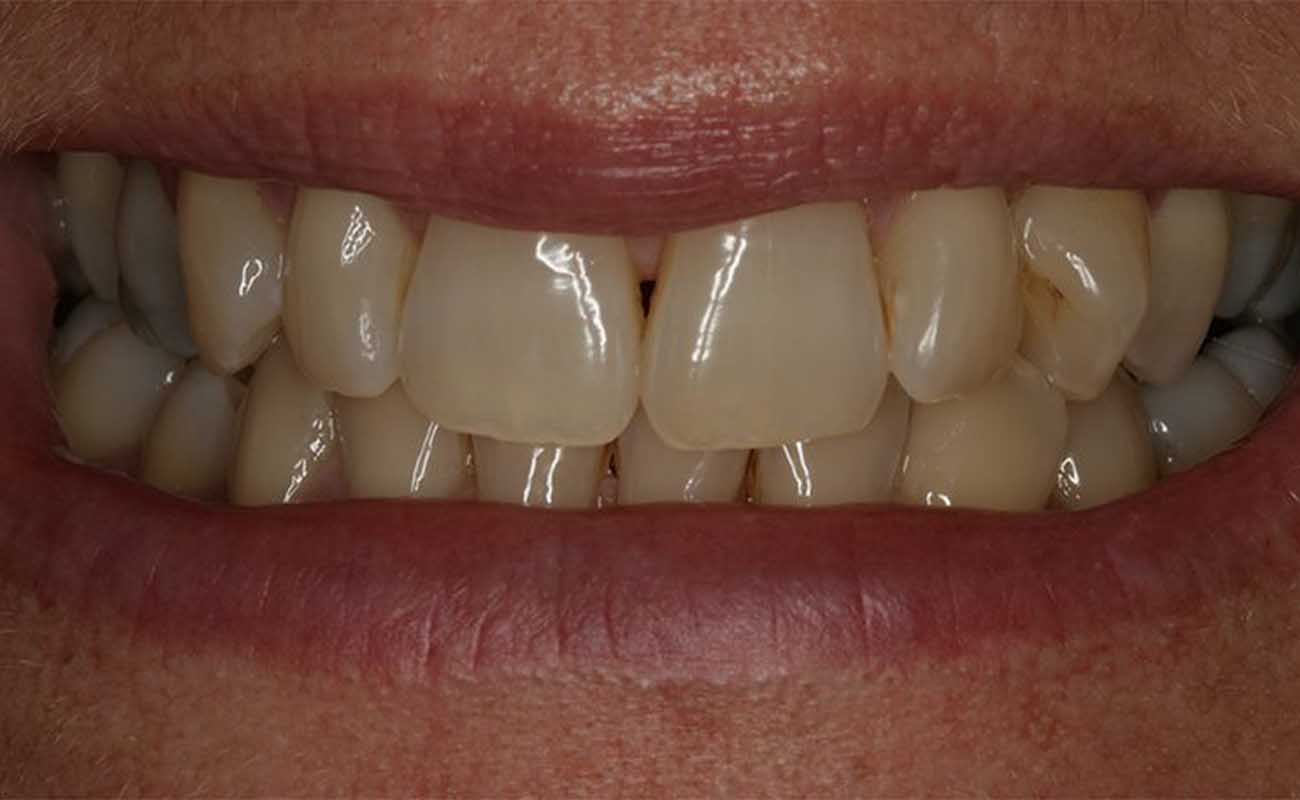Treatment Before Image Reading | Aspire Clinic