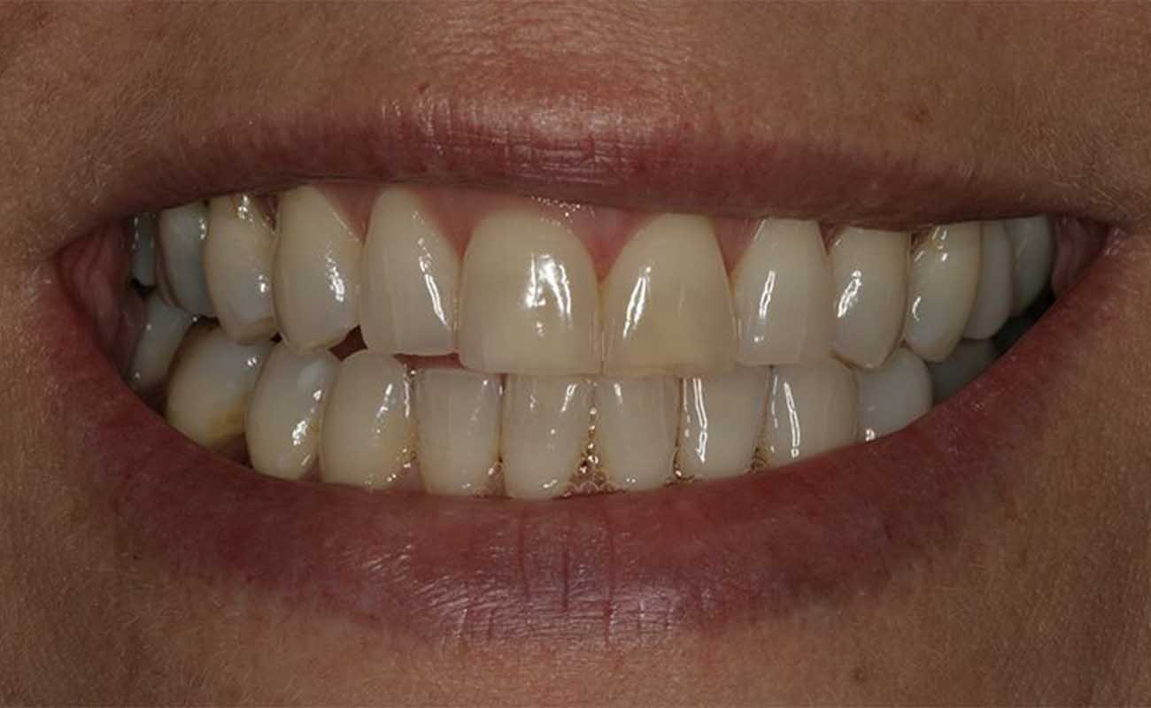 Treatment Before Image Reading | Aspire Clinic