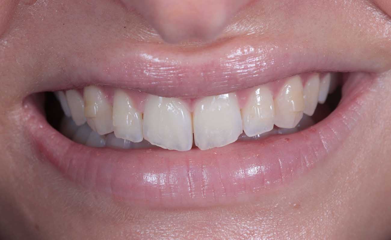 Treatment Before Image Reading | Aspire Clinic