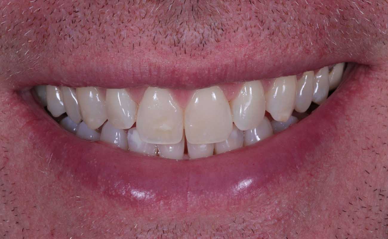 Treatment Before Image Reading | Aspire Clinic