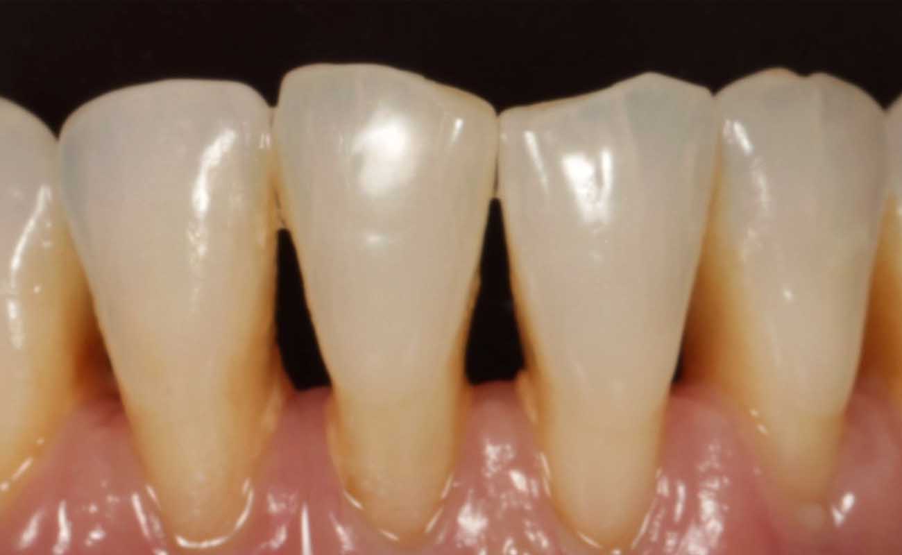 Treatment Before Image Reading | Aspire Clinic