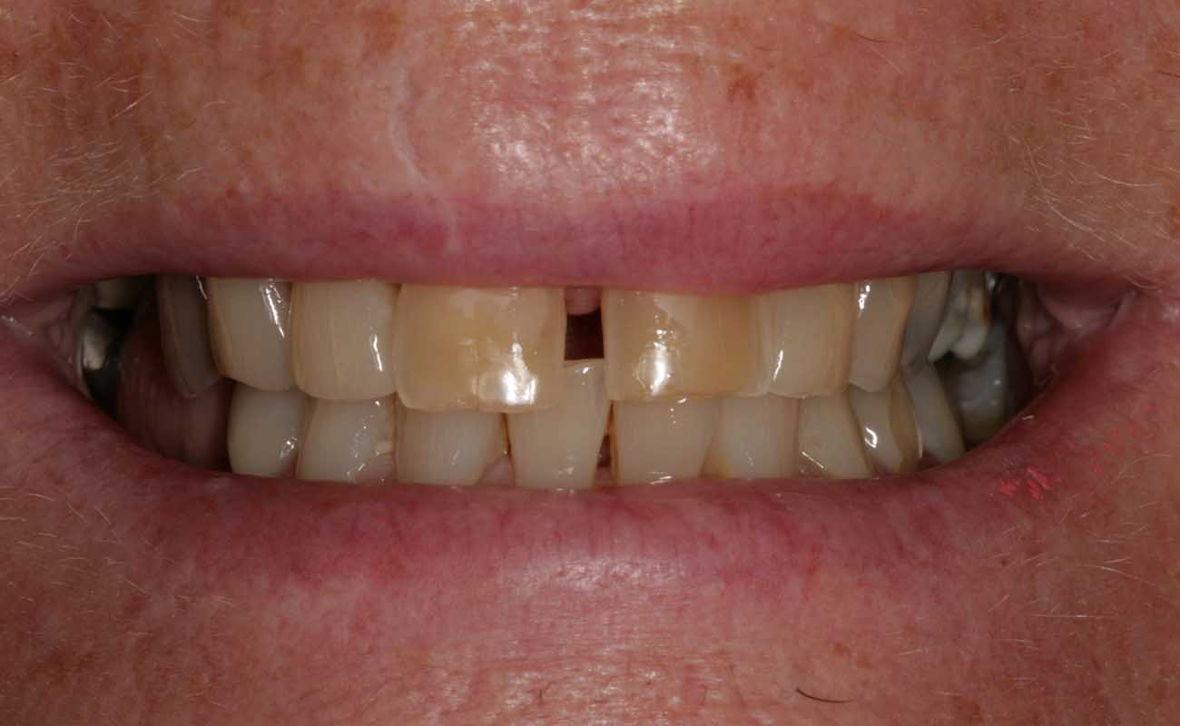 Treatment Before Image Reading | Aspire Clinic