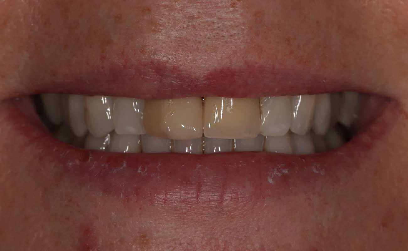 Treatment Before Image Reading | Aspire Clinic