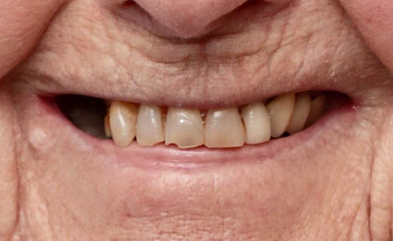 Treatment Before Image Reading | Aspire Clinic