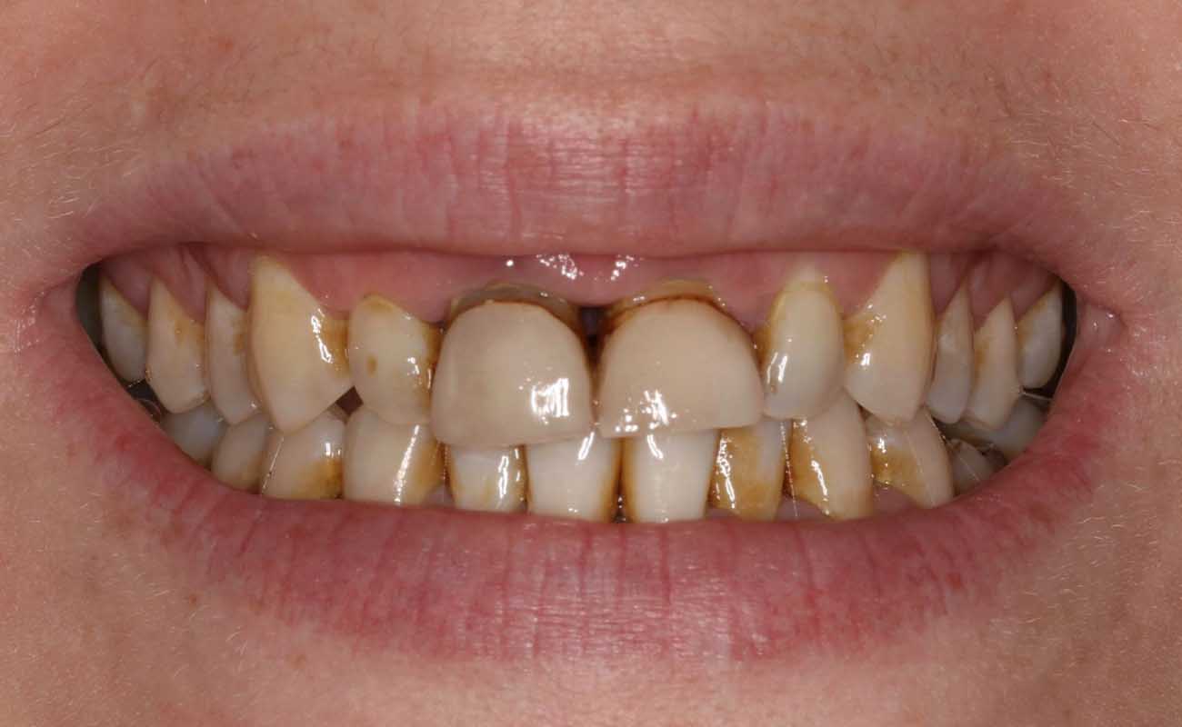Treatment Before Image Reading | Aspire Clinic