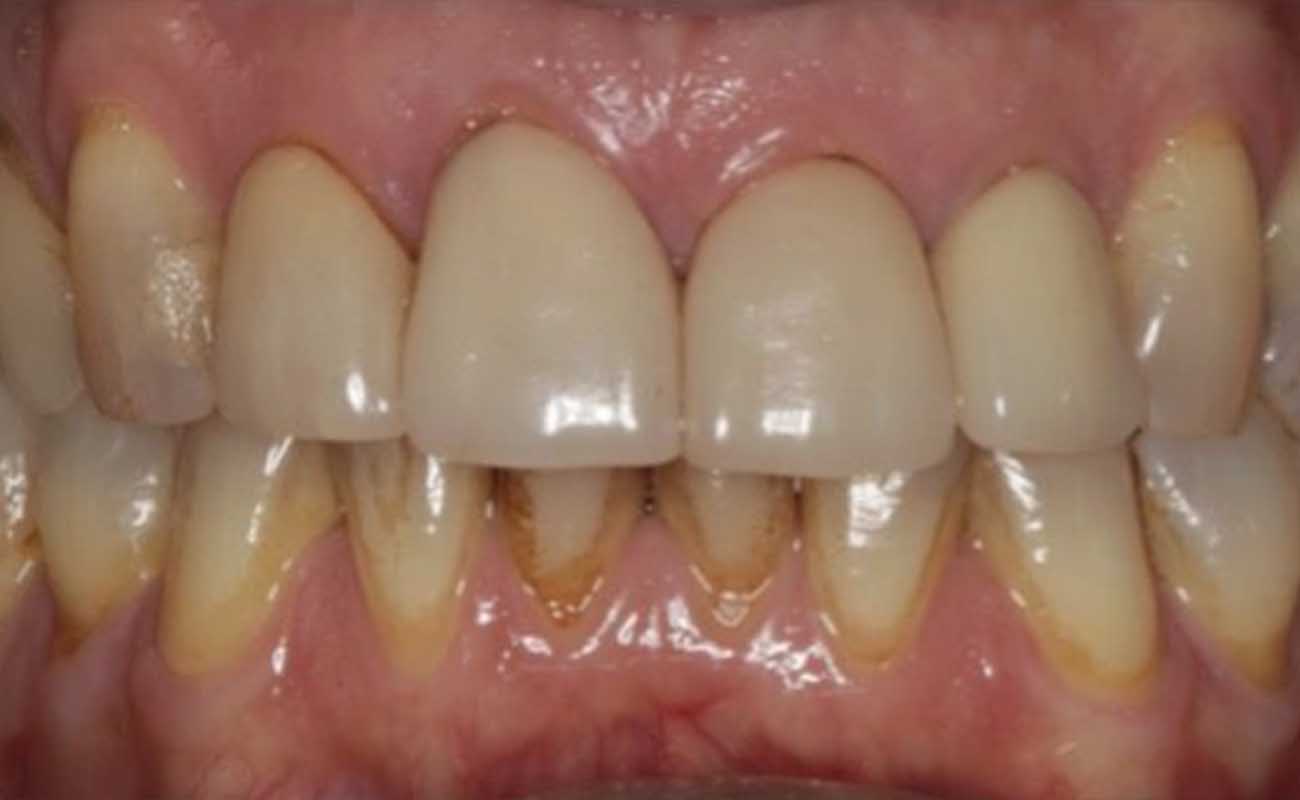 Treatment Before Image Reading | Aspire Clinic