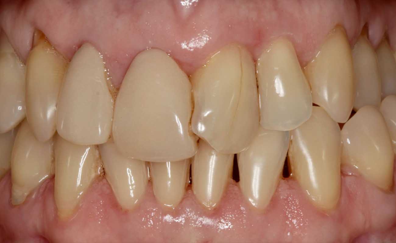 Treatment Before Image Reading | Aspire Clinic