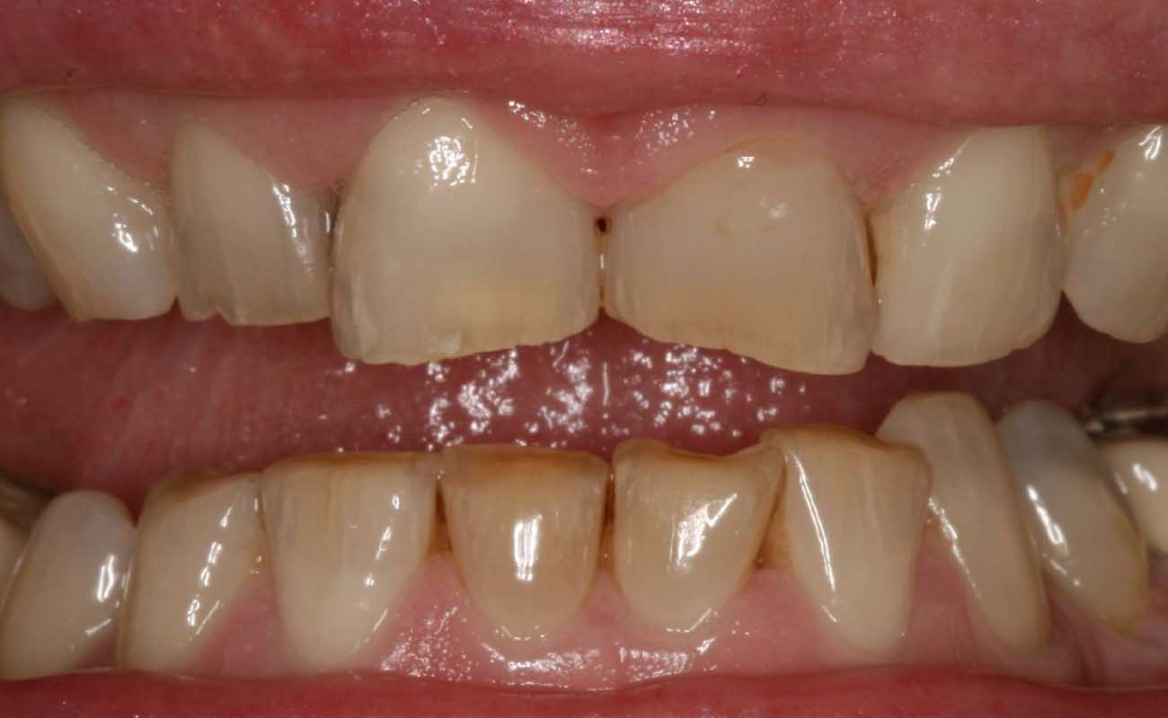 Treatment Before Image Reading | Aspire Clinic