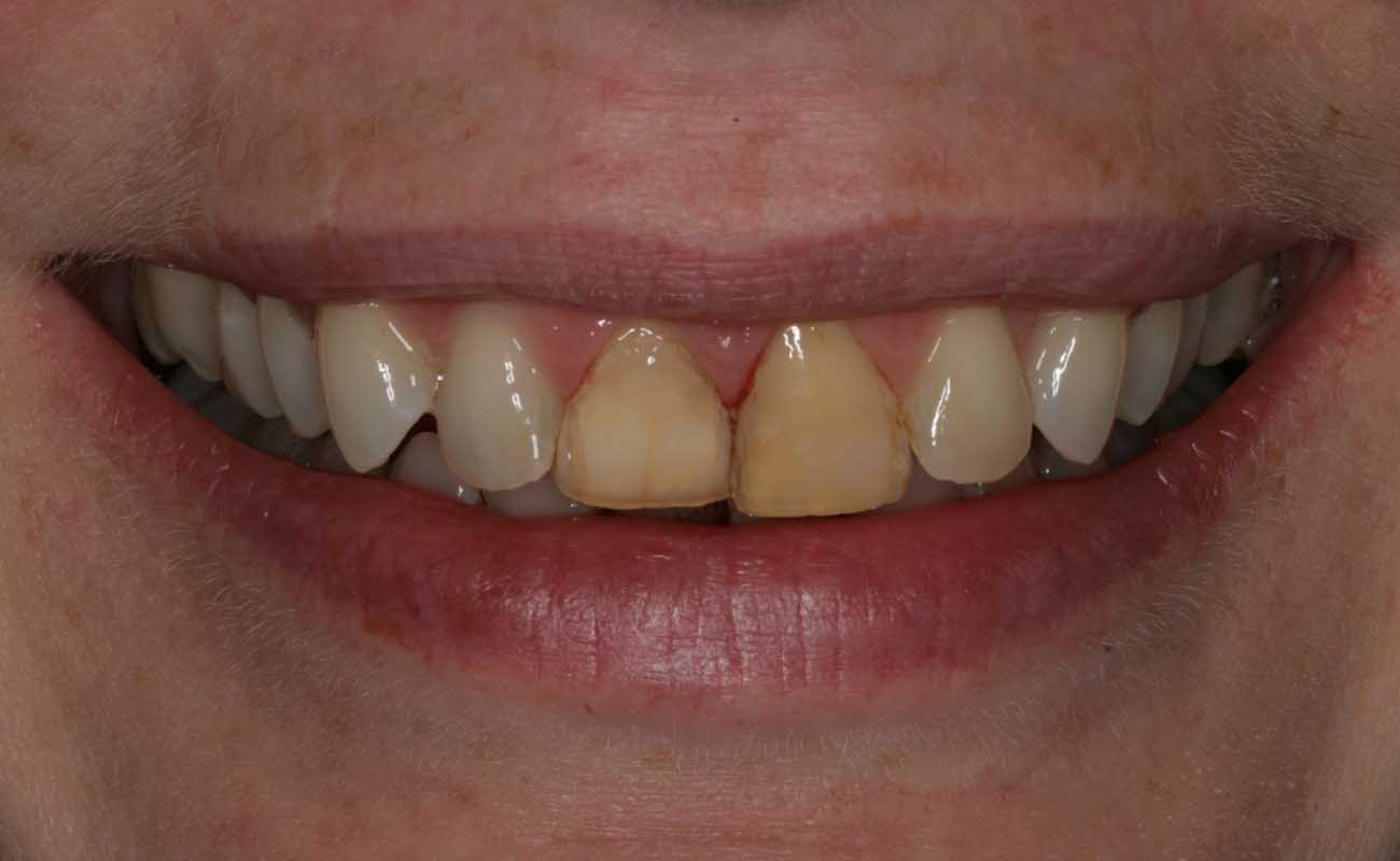 Treatment Before Image Reading | Aspire Clinic