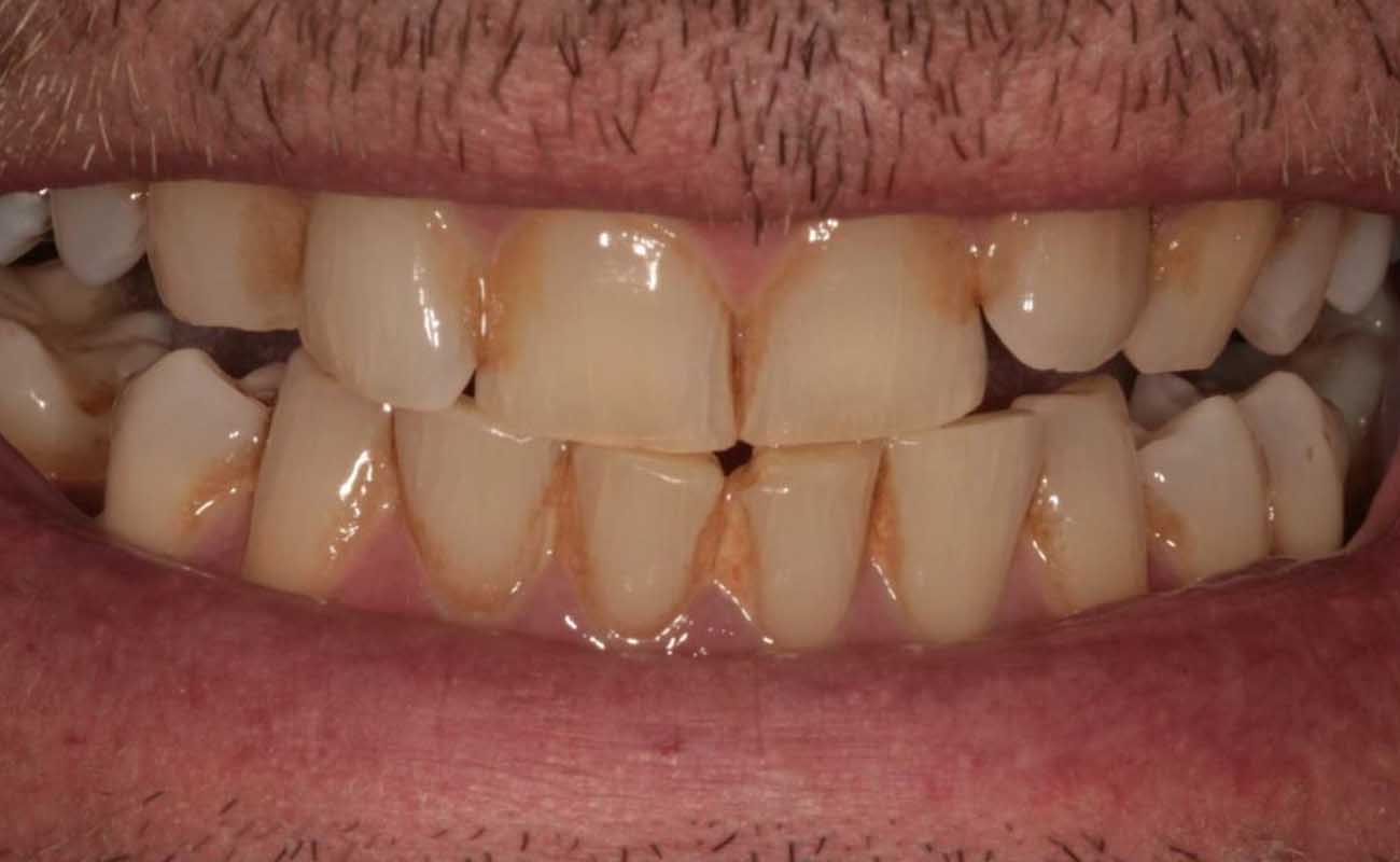 Treatment Before Image Reading | Aspire Clinic