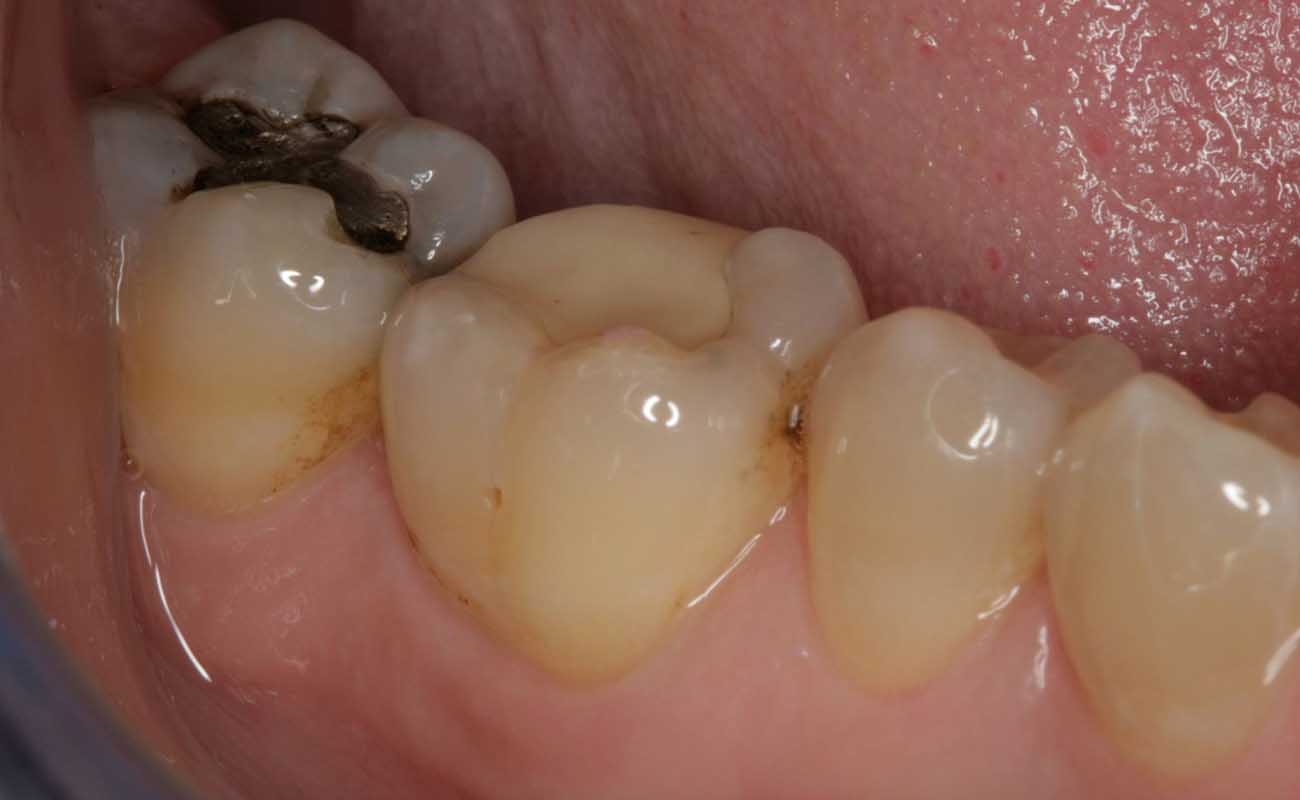 Treatment Before Image Reading | Aspire Clinic